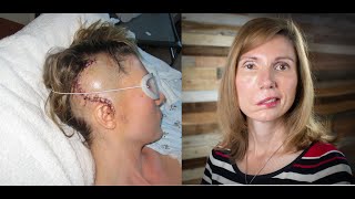 Brain Tumor Journey 2: From dizzy spells, headaches, vertigo, to diagnosis, Jodi Orgill Brown