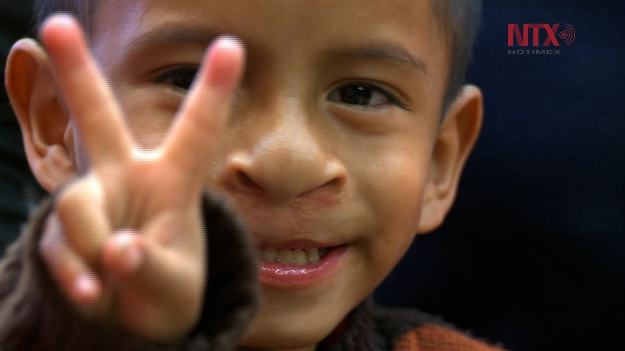 Como Es El Lenguaje De Un Niño Con Paladar Hendido