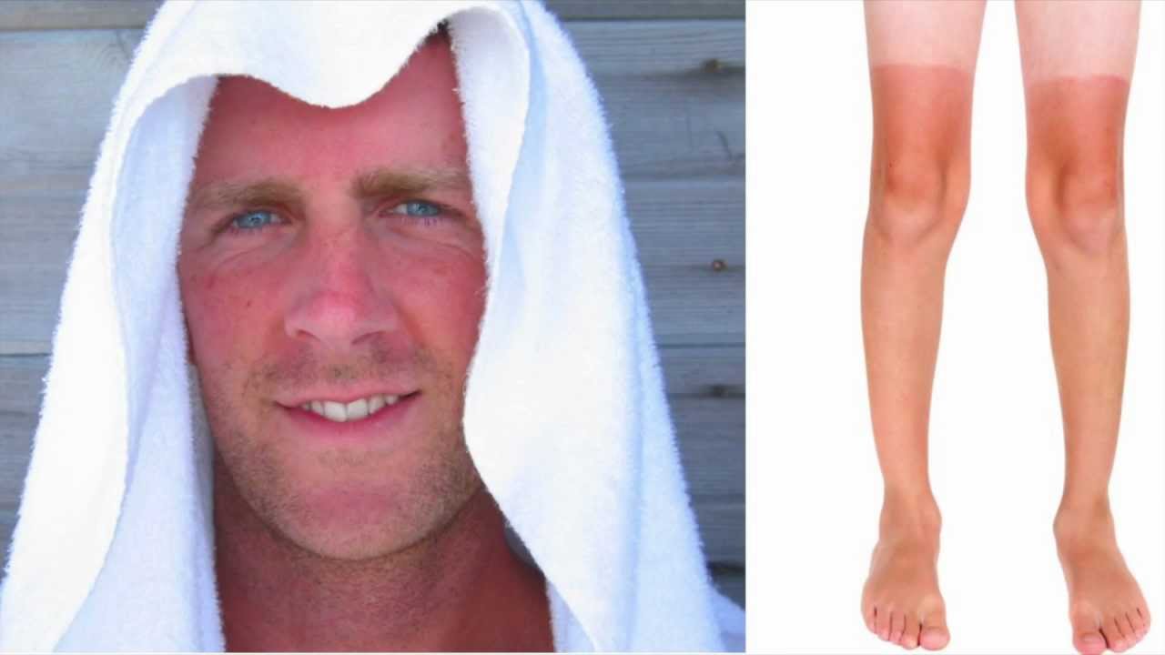 Sun Damage - What is it?