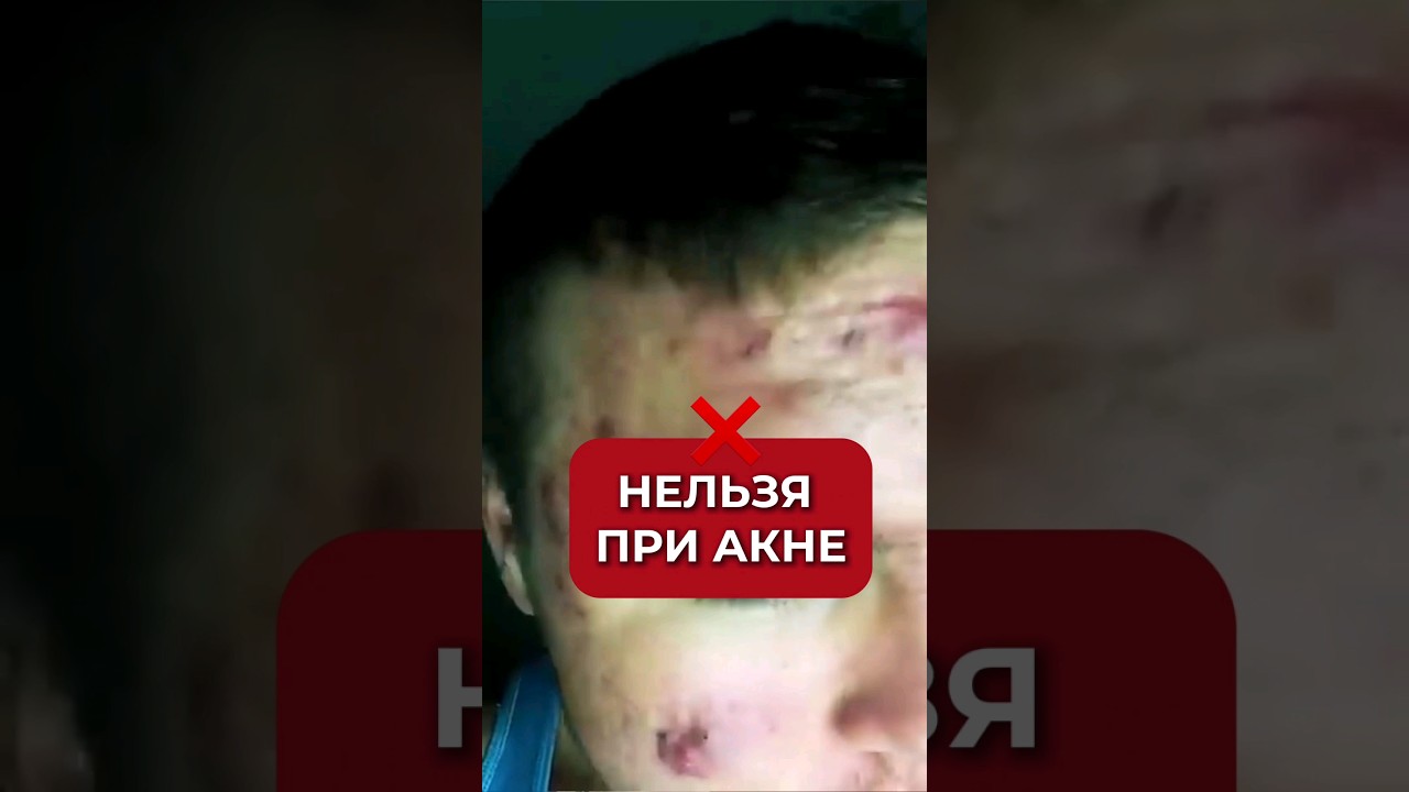 При акне НЕЛЬЗЯ! #аюна #акне #прыщи #уходзалицом #угри #проблемнаякожа #черныеточки #косметолог