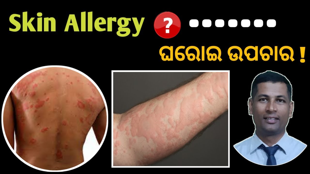 Skin allergy Treatment at home Get Rid of skin Allergy Food allergy