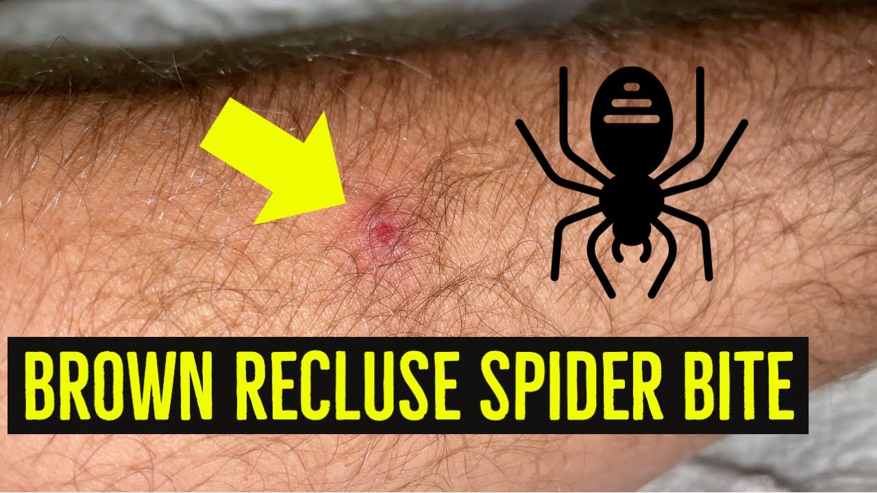 recluse-spider-bite