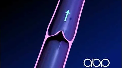 Leg Vein Valve - Normal - 3D Medical Animation || ABP ©