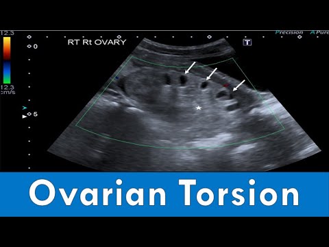 Ovarian Torsion