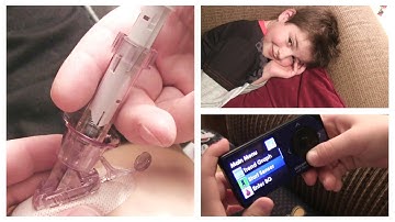 Dexcom G4 Sensor Insertion Tutorial | Continuous Glucose Monitor | Type I Tuesday #DexcomG4