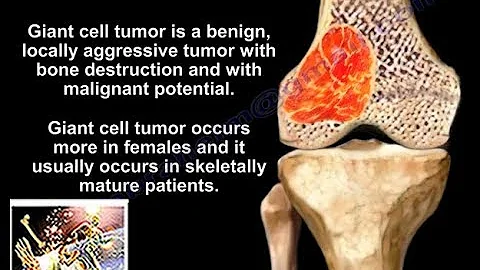 Giant Cell Tumor - Everything You Need To Know - D...