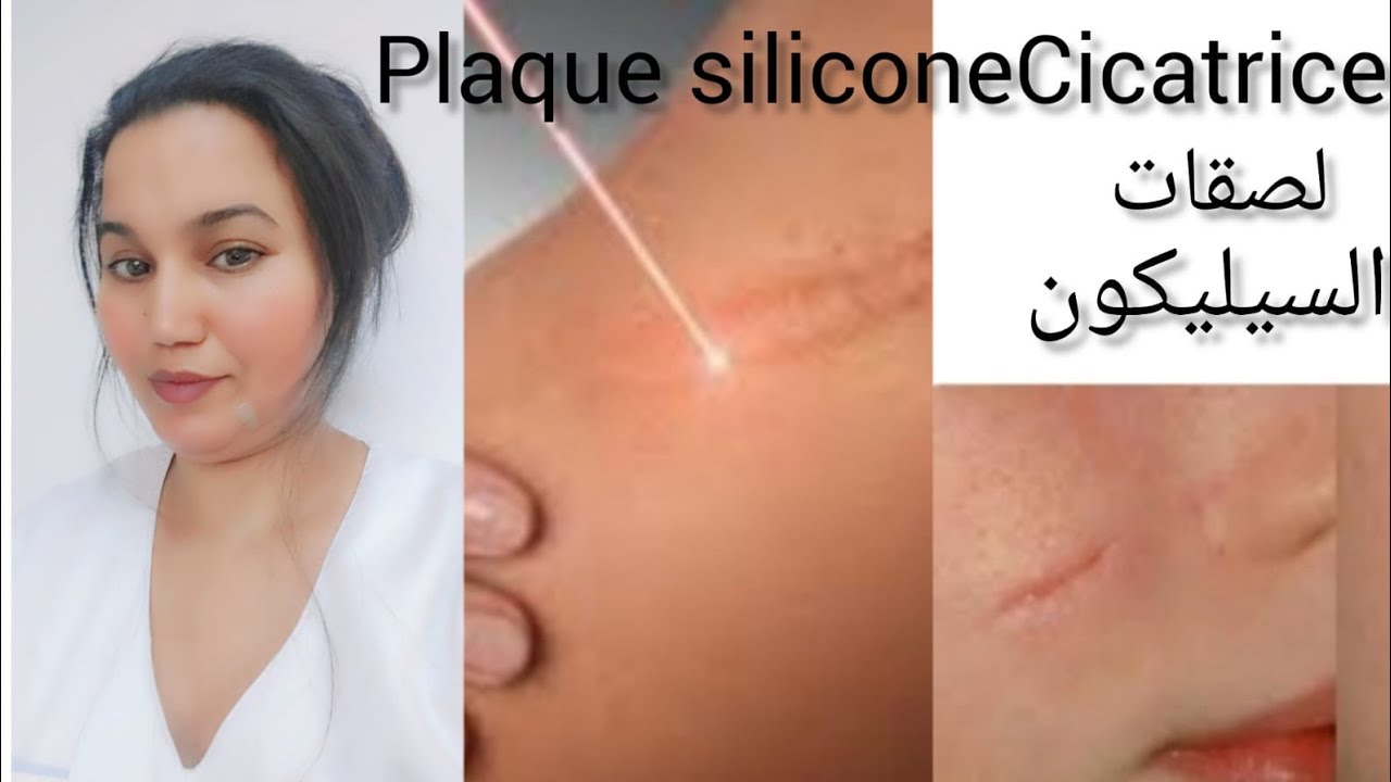 علاج ندبات والجروح وطريقة استخدام لصقات السيليكون #Plaque silicone Cicatrice