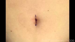 Making Umbilical Incision Making Umbilical Incision
