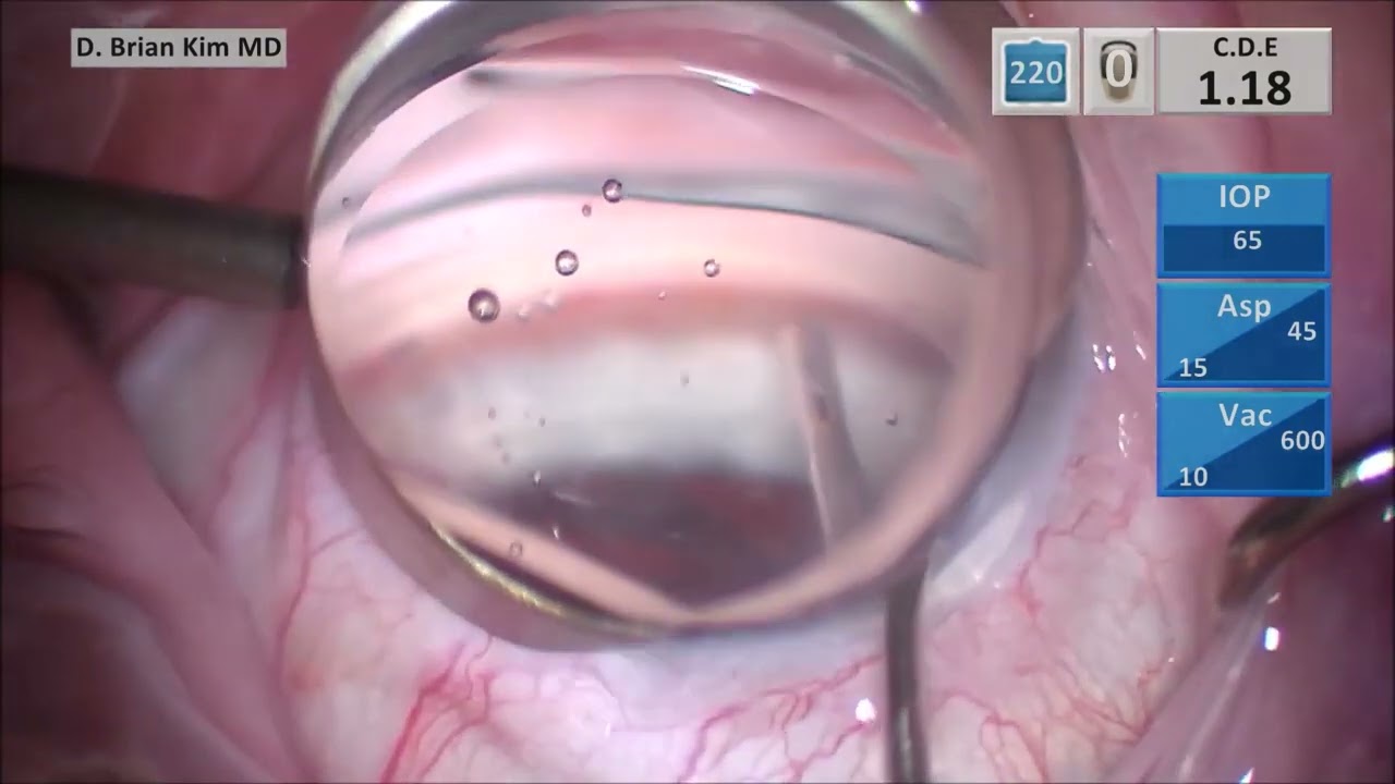 Keys to Success with iStent Inject W - Pearls to Maximize Space Between the First and Second Stent