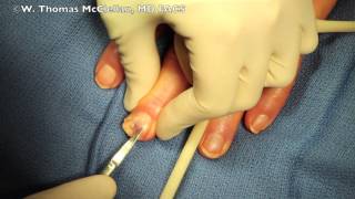 Live Surgery: How to remove a fingernail.