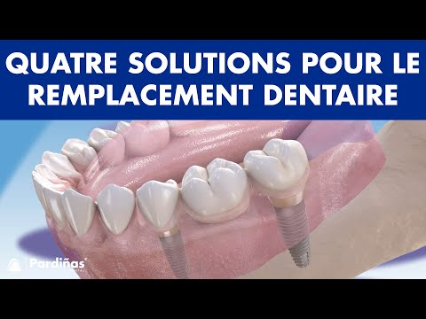 Vidéo: 3 façons de remplacer une dent