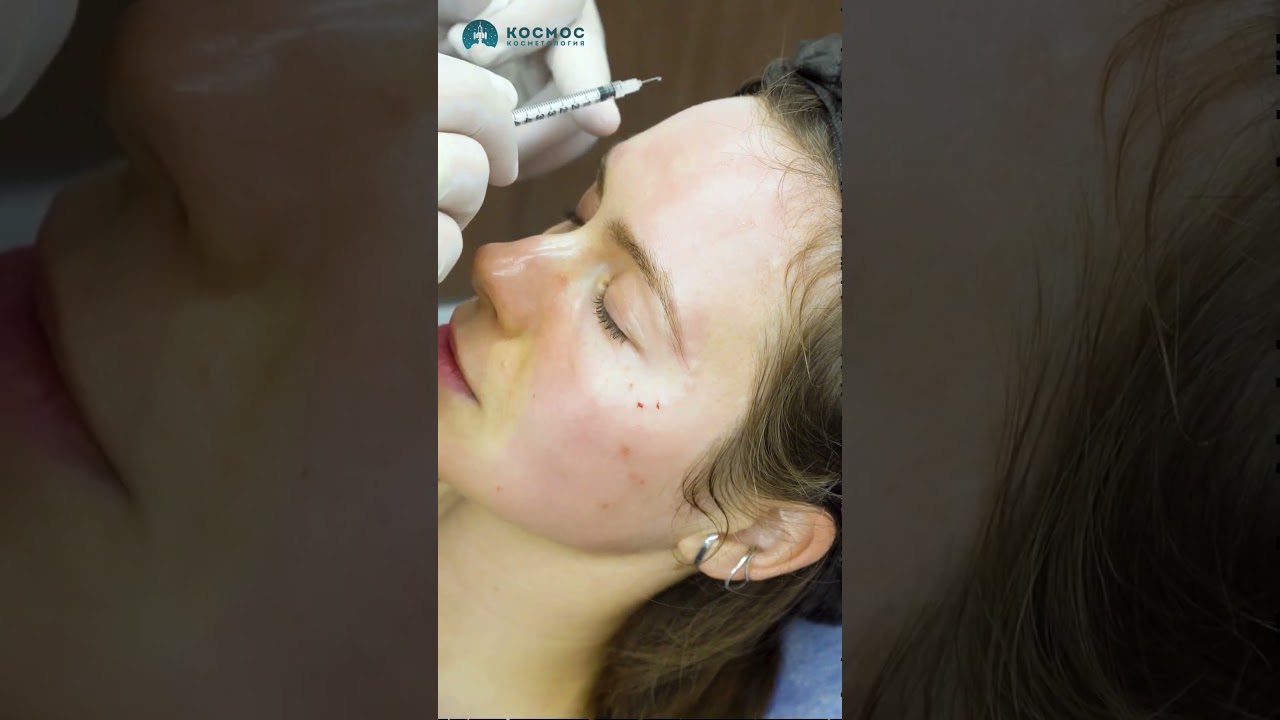 Сколько единиц ботокса нужно для морщин на лбу #комплекснаяпроцедура #доипосле