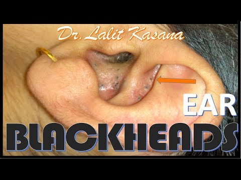 EAR COMEDONES by Dr.Lalit Kasana