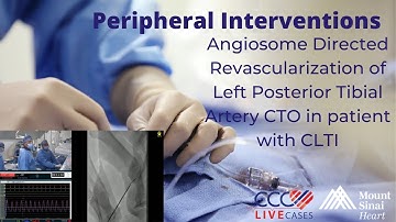 Angiosome Directed Revascularization of Left Posterior Tibial Artery CTO  in patient with CLTI