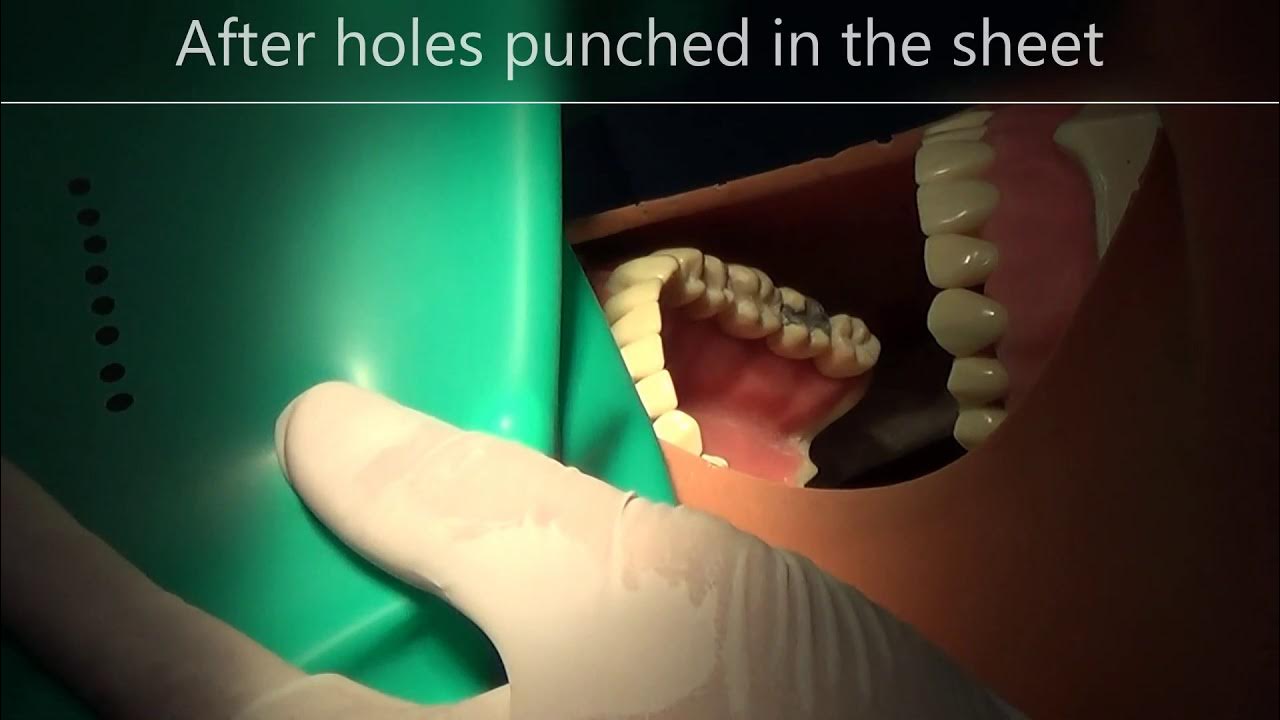 Rubber dam placement YouTube