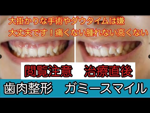 笑った時にみえすぎる歯茎と小さい歯がずっと悩みだったという綺麗な女性
