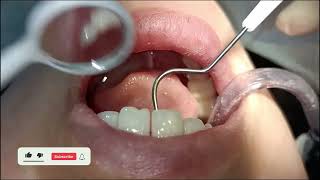 Teeth Cleaning Videos, Top Dentist ASMR, Dental treatment, Bracket Teeth, Tooth Braces by Dr Yayayue (牙牙月姐) 23 views 4 months ago 3 minutes, 16 seconds