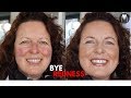 Makeup Tips for Redness and Rosacea - How to cover that redness?