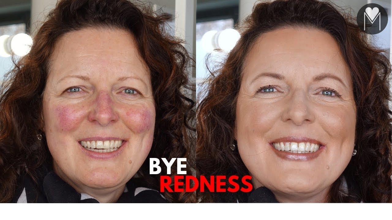 Makeup Tips for Redness and Rosacea How to cover that redness? YouTube