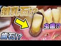 鍾乳石の様な歯石除去&親知らずのせいで隣が虫歯に..😢【tartar】Stalactite-like tartar removal& wisdomteeth decayed adjacentteeth
