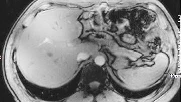 Simulation Coil B1 Fields and Healthy Volunteers Whole Body Imaging