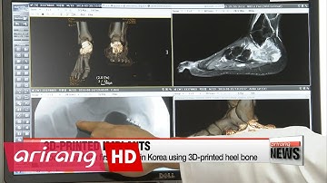 Doctors perform first surgery in Korea using 3D-printed heel bone