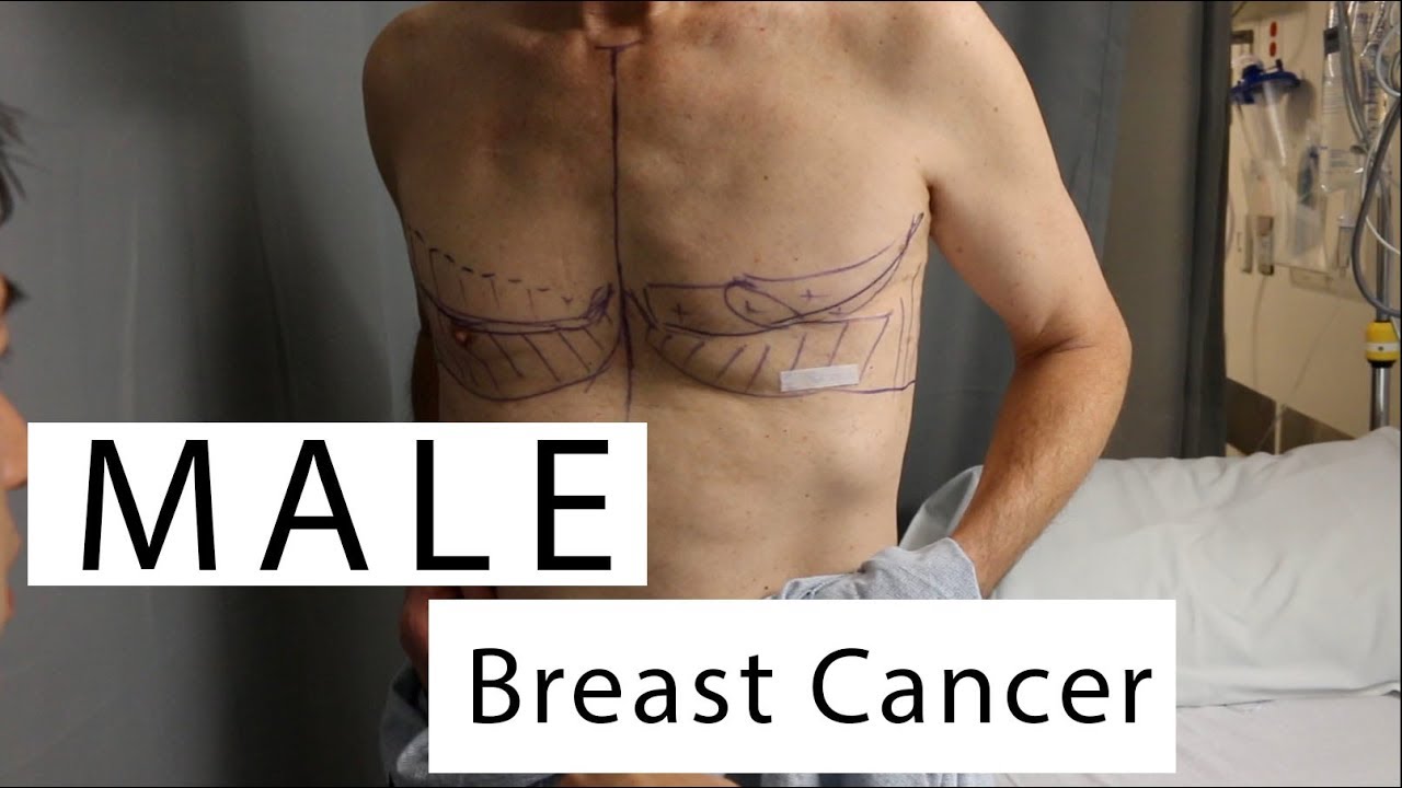 Male Breast Cancer Reconstructive Surgery YouTube