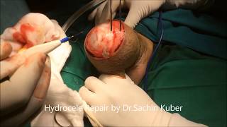 Hydrocele Surgery by Dr.Sachin Kuber MS,Pune,India Sun Clinic WA+91 9832136136