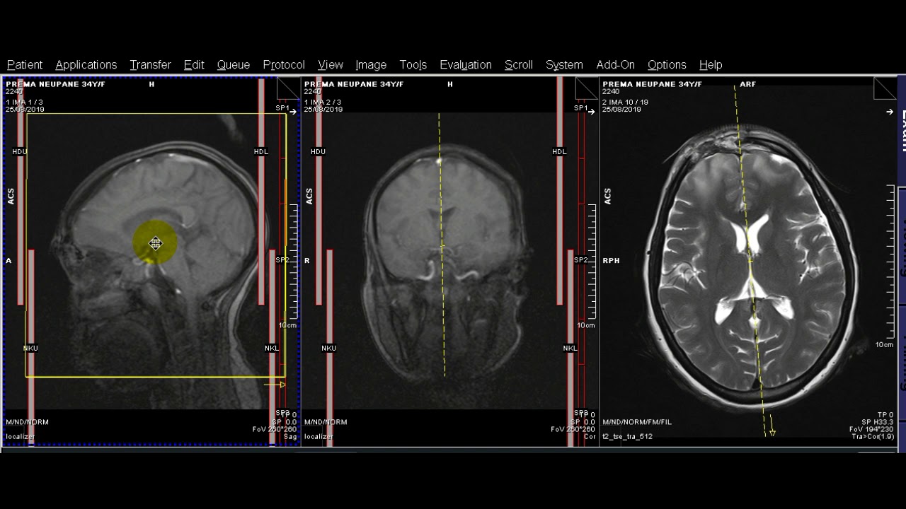 MRI Brain plain YouTube MRI Brain plain YouTube