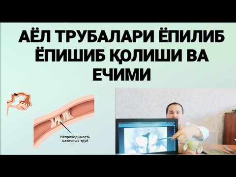 АЁЛ ТРУБАЛАРИ ЁПИШИБ ҚОЛИШИ (непроходимость маточных труб)