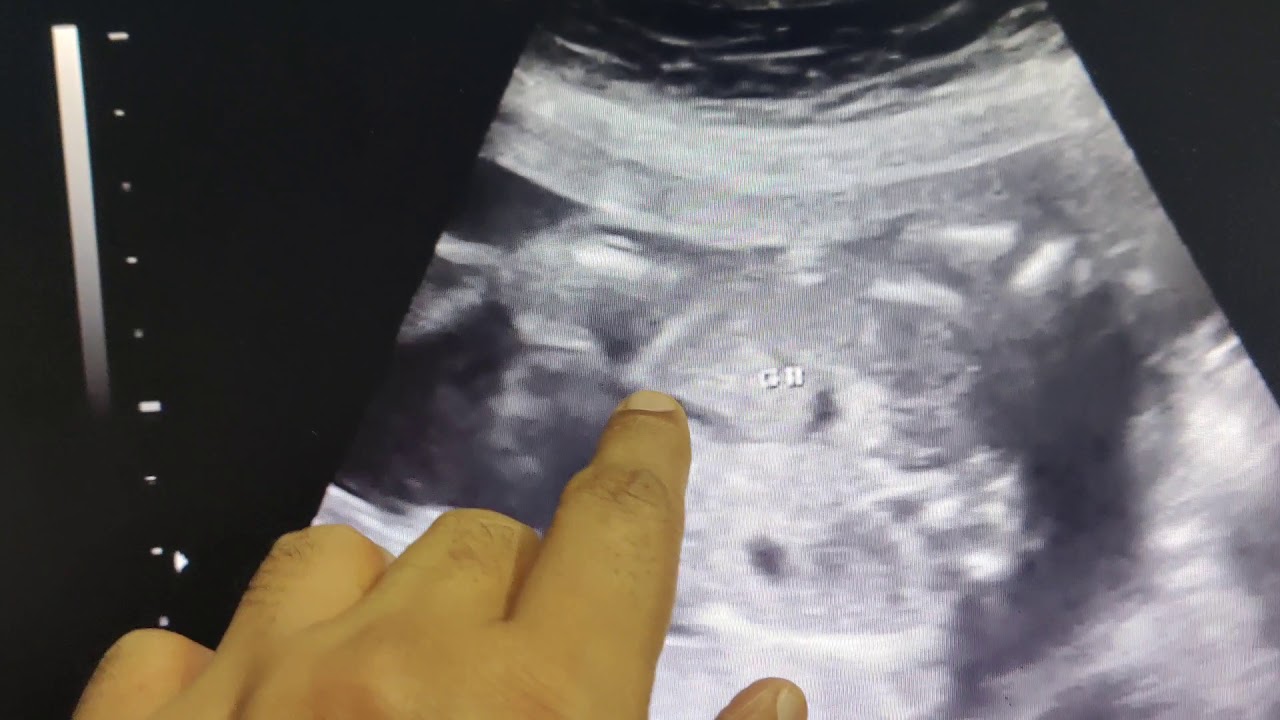 Fetal GB from stomach -SSS- Dr.Arul's USG TV