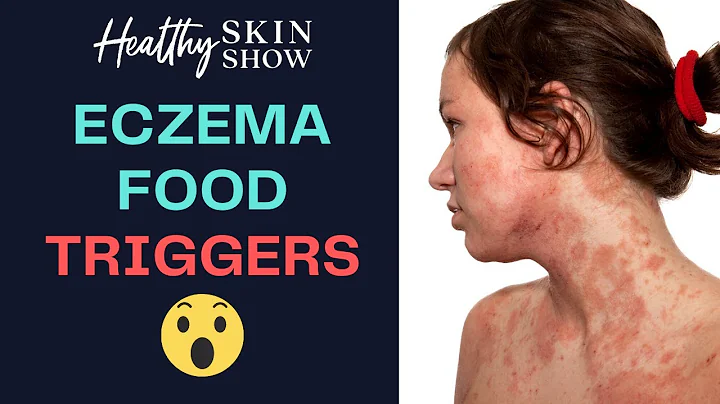 Eczema FOOD TRIGGERS From An Eastern Medicine Pers...