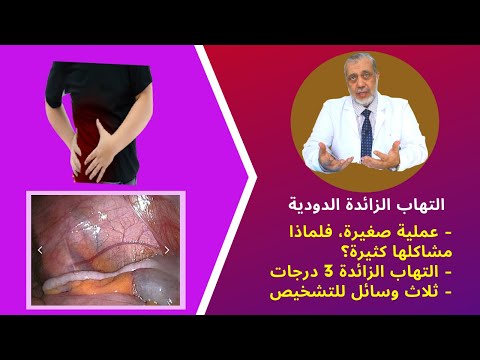 التهاب الزائدة الدودية: د  علي بطيخ يشرح كل المعلومات الصحيحة عن الزائدة وأعراضها وعملياتها