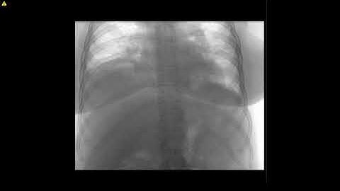 Diaphragm paralysis fluoroscopy