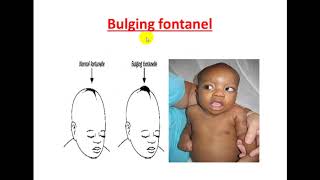 محاضرة علمية(المرحلة الرابعة / طب الاطفال /Meningitis and Encephalitis)