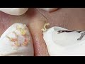 Acne Removal Technique Hidden Under The Skin P1 | Mụn Ẩn Sâu Dưới Da P1 - SacDepSpa#215