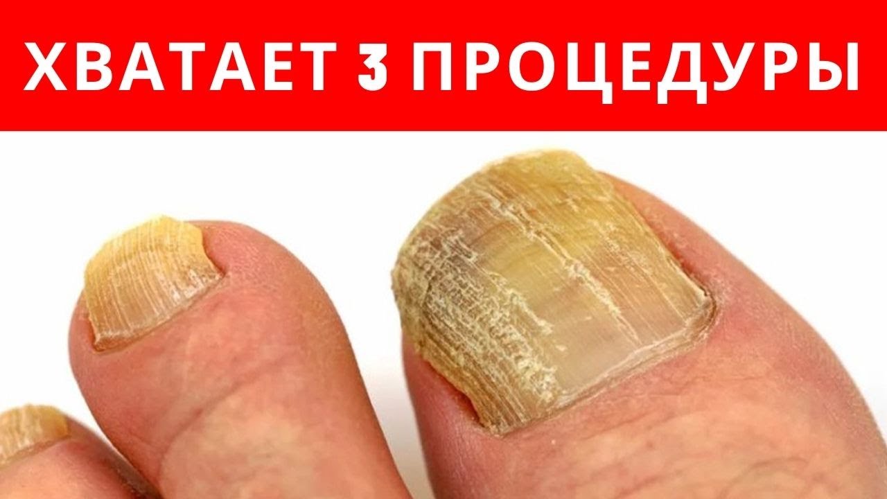 ХВАТАЕТ 3-х ПРОЦЕДУР от ГРИБКА НОГТЕЙ