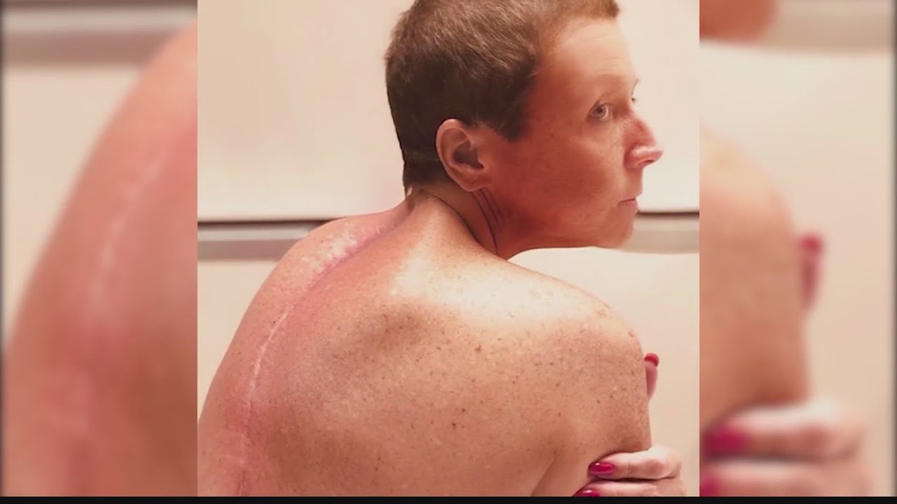 Dance Moms Coach, Abby Lee Miller shows off spinal surgery scar.