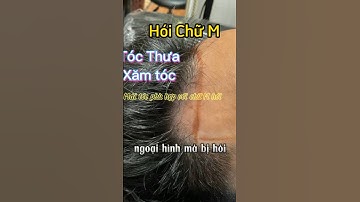 Hói chữ M và cách khắc phục lập tức, #xămtóc #scalp #tócthưa  #Hóichữm