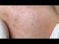 Acne Treament Under The Skin #045