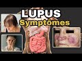 Symptmes les plus frquents du lupus