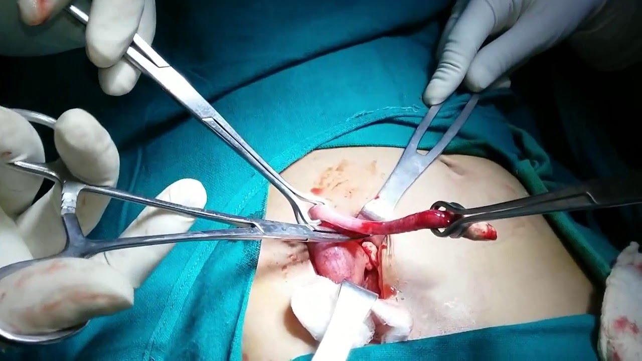 Appendicectomy Youtube