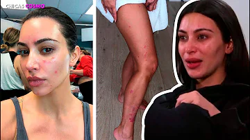 ¿Qué Kardashian tiene una enfermedad de la piel?