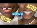 HOW TO CLOSE THE GAP IN YOUR TEETH - INVISALIGN BEFORE AND AFTER REVIEW
