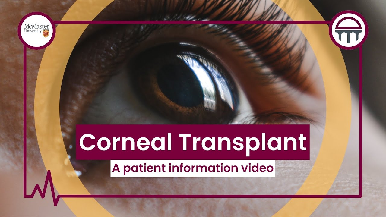 Операция по пересадке роговицы: информационный видеоролик для пациентов