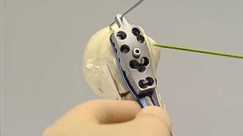 PHILOS The Proximal Humerus Internal Locking System by Adiy Ortho Point