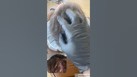 Fuller hair using Scalp Micropigmentation at Ink & Ashberry
