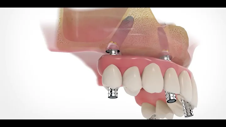 Modern Full-Arch Implant Solutions | All on 4 Implants Procedure (Animation)