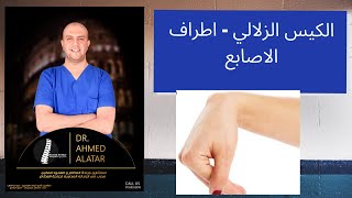 الكيس الزلالي في مفصل اليد...كيفية التشخيص والعلاج ( باذن الله) د احمد العطار