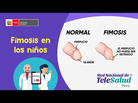 Vídeo: Fimosis - Fimosis En Niños